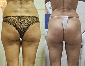 Wonder Axon treatment results